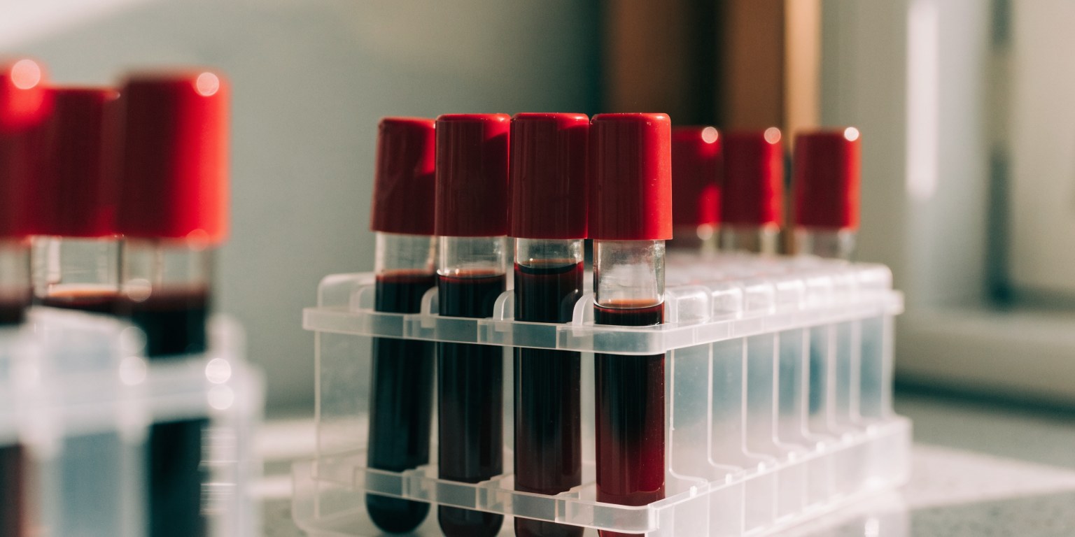 Provette di sangue in laboratorio per l'esame della lipoproteina a (Lp(a))