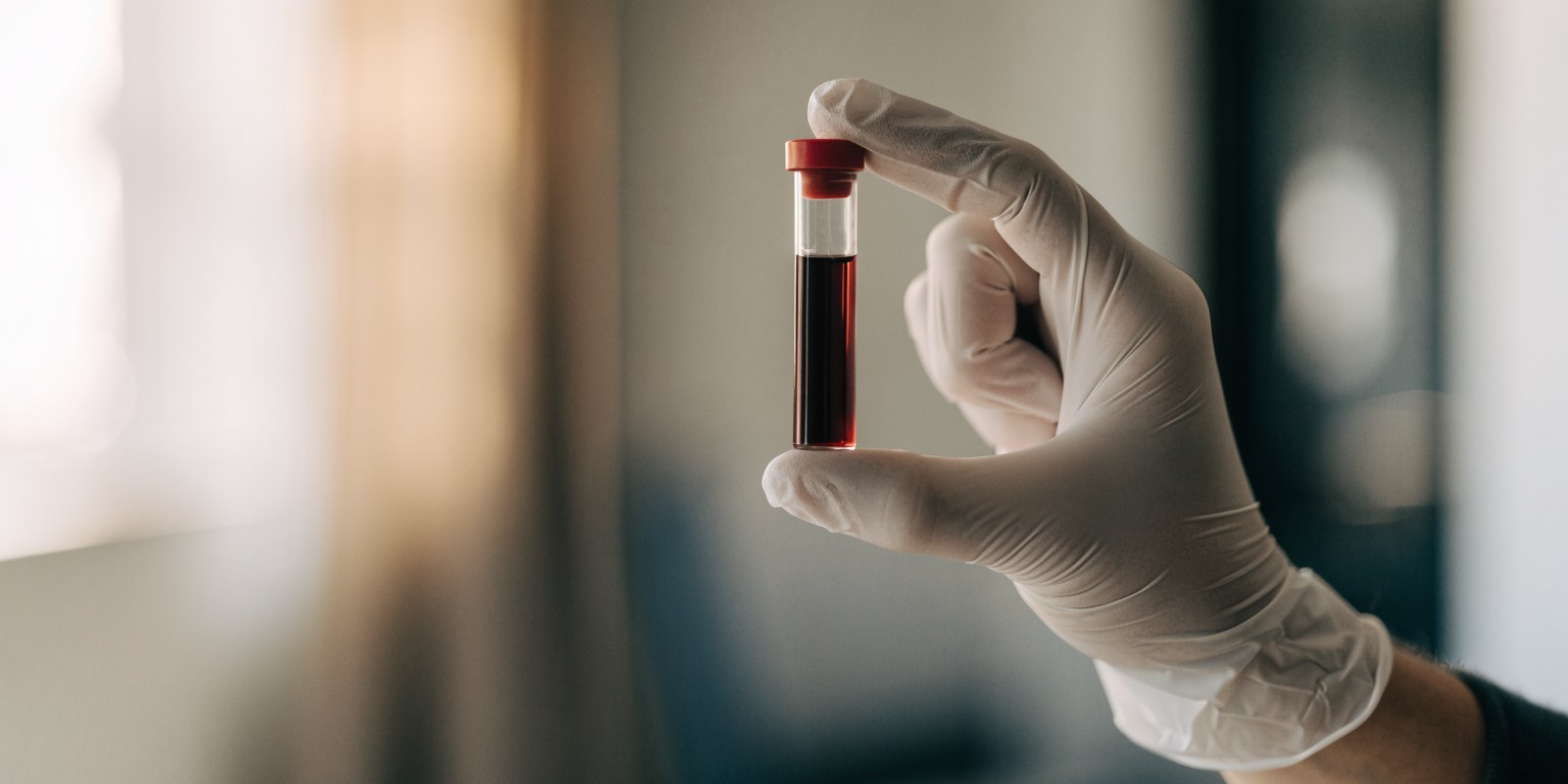 Provetta di sangue analizzata per il dosaggio dell'omocisteina